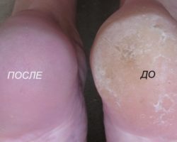 Лечение_грубых_пяток